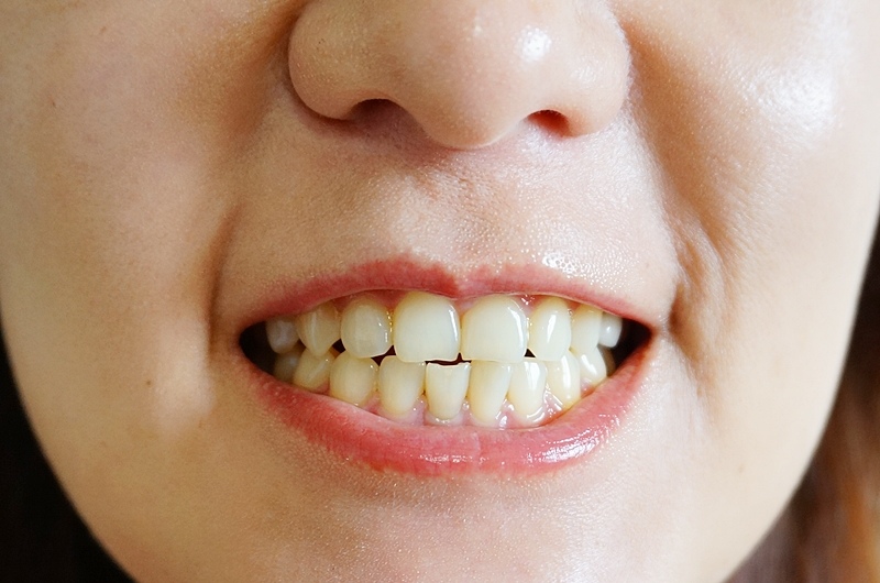【牙齒矯正推薦】YA!SMILE輕矯正隱形牙套。療程時間短、費用便宜，輕微齒列不整、二次矯正適用｜新莊福美牙醫診所 @PEKO の Simple Life